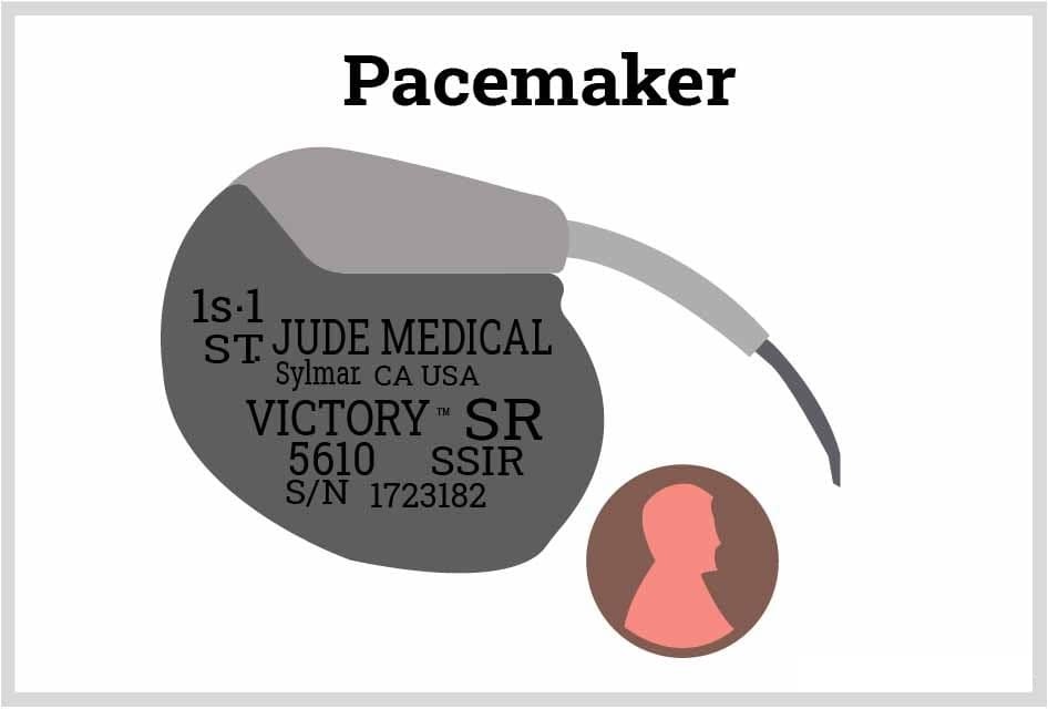 pacemaker